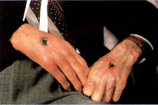 What Is A Stigmata Medical Term