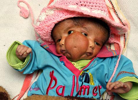 Two headed baby in India