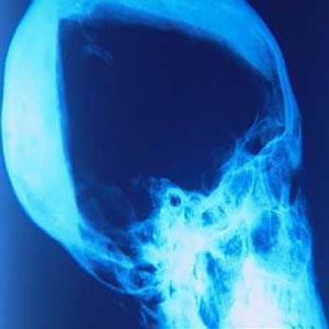 Tutankhamun Skull X-Ray