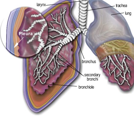 Mesothelioma